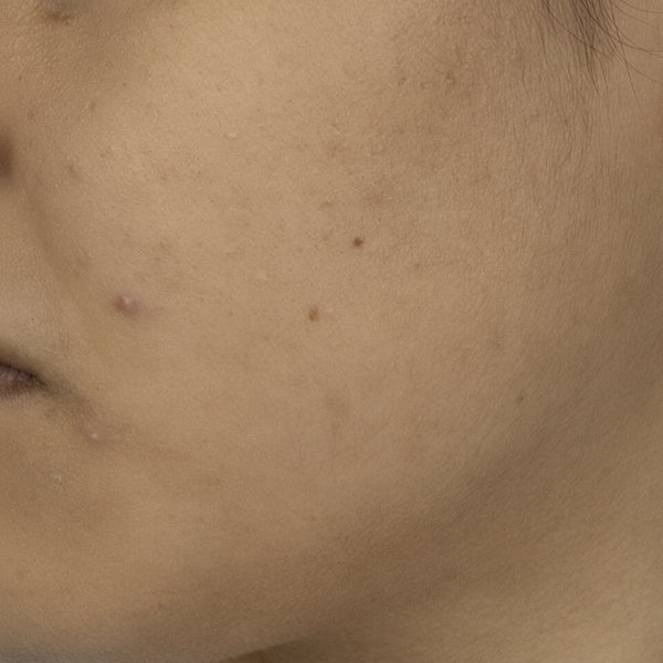 Dark Spots