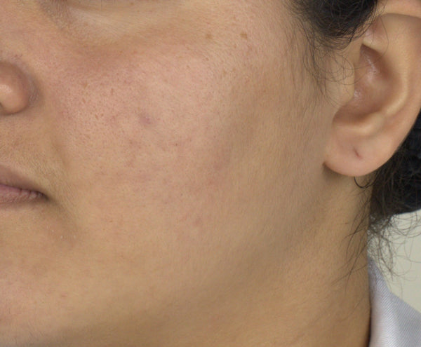 Dark spots