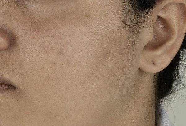 Dark spots
