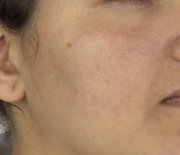 Uneven Skin Tone