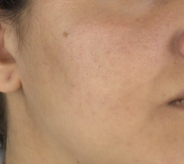Uneven Skin Tone